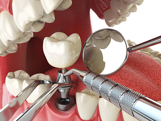 Best Emergency Tooth Extraction in Frazee, MN